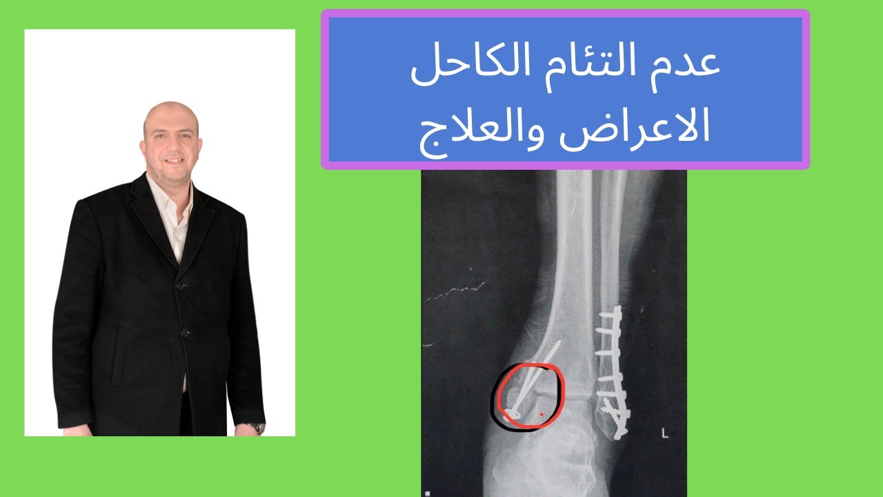 عدم التئام الكاحل الاعراض والعلاج للدكتور احمد العطار