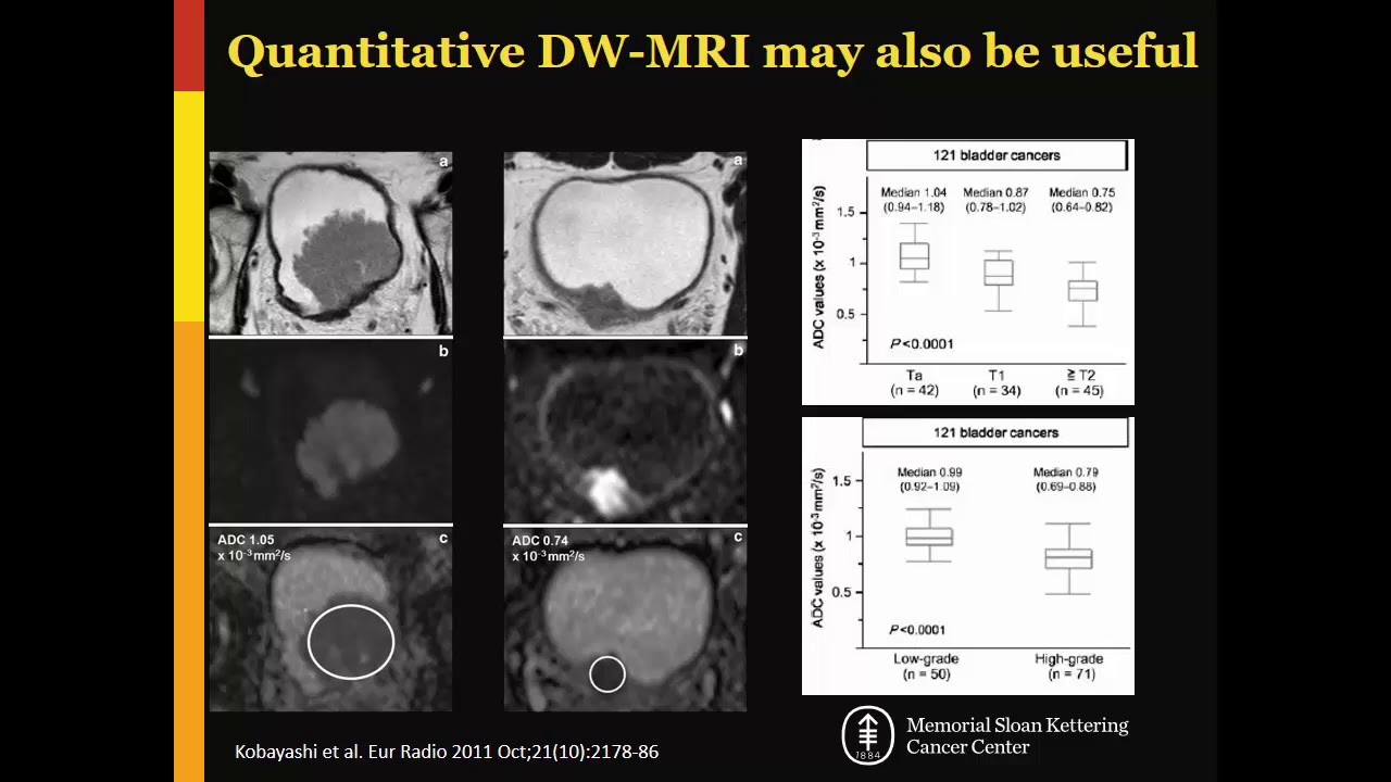 ISMRM MR Academy - Bladder CA Staging