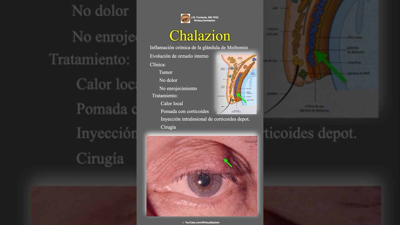 Chalación | Calacio | Chalazión. #eyes #science #biology #education #chalazion