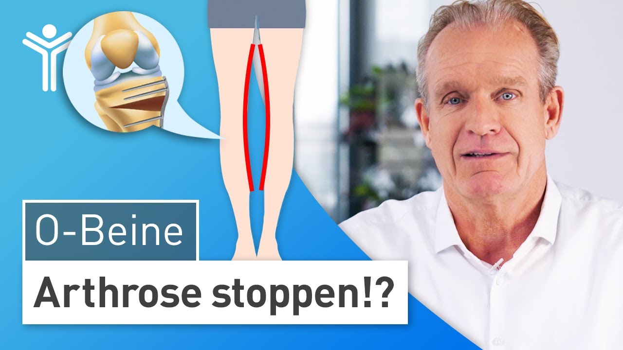 O-Beine: Was tun? | Wissenswertes zur Fehlstellung der Beinachsen
