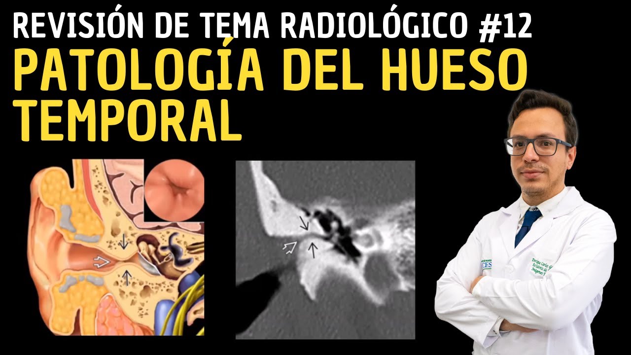 Revisión de Tema 12: Patología del Hueso Temporal.