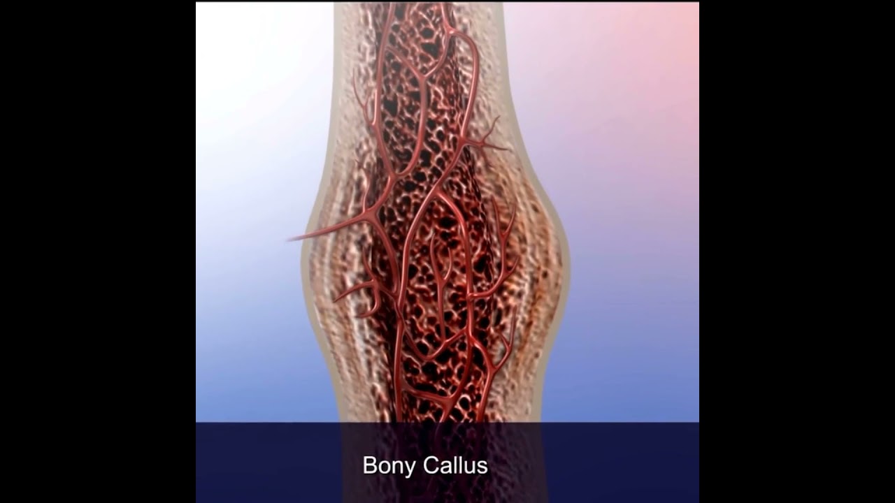 Bone Fractures: Proper Healing