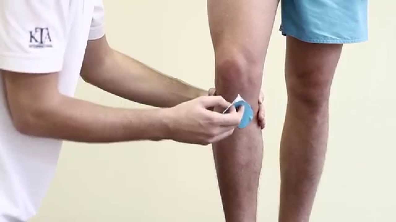 Кинезиотейпирование передней крестообразной связки