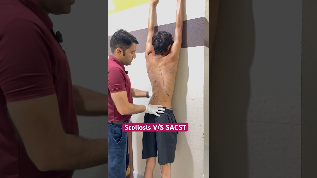 Best Scoliosis Exercise By DrRavi 