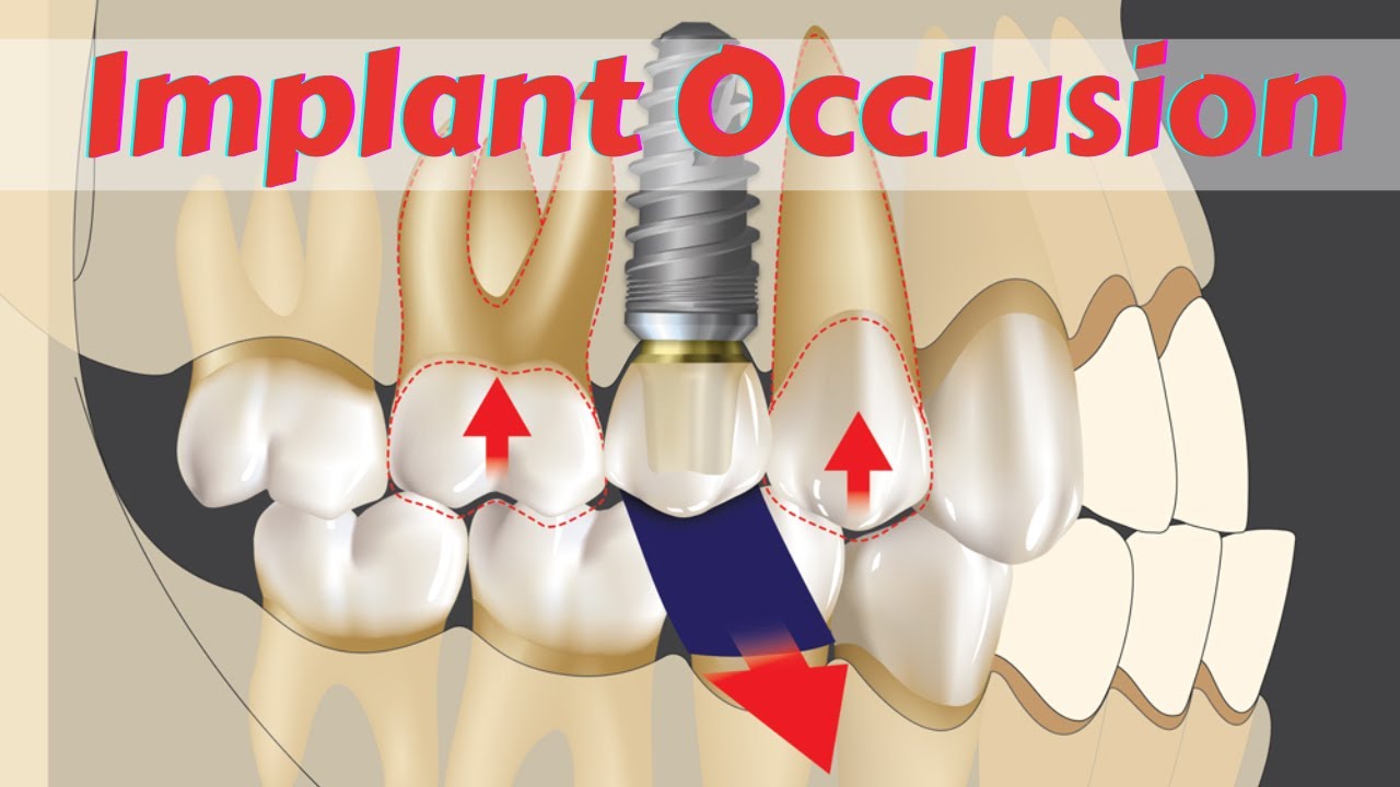Principles of #dental  #implants  Occlusion and Various Consideration- Save Implant from Failure