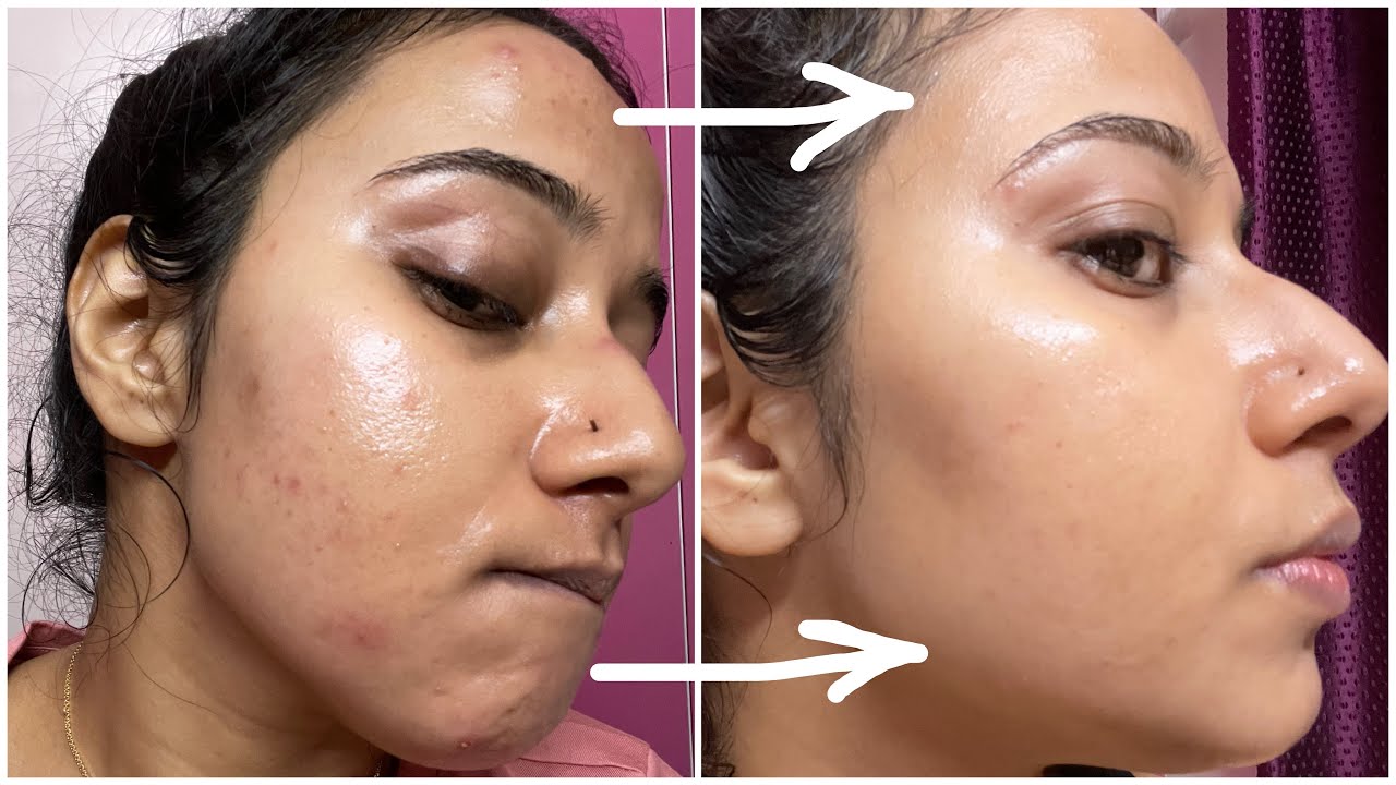 The Best FACE WASH to Remove Pimples, Tiny Bumps, Blackheads, Whiteheads & Oiliness ( Real Result )
