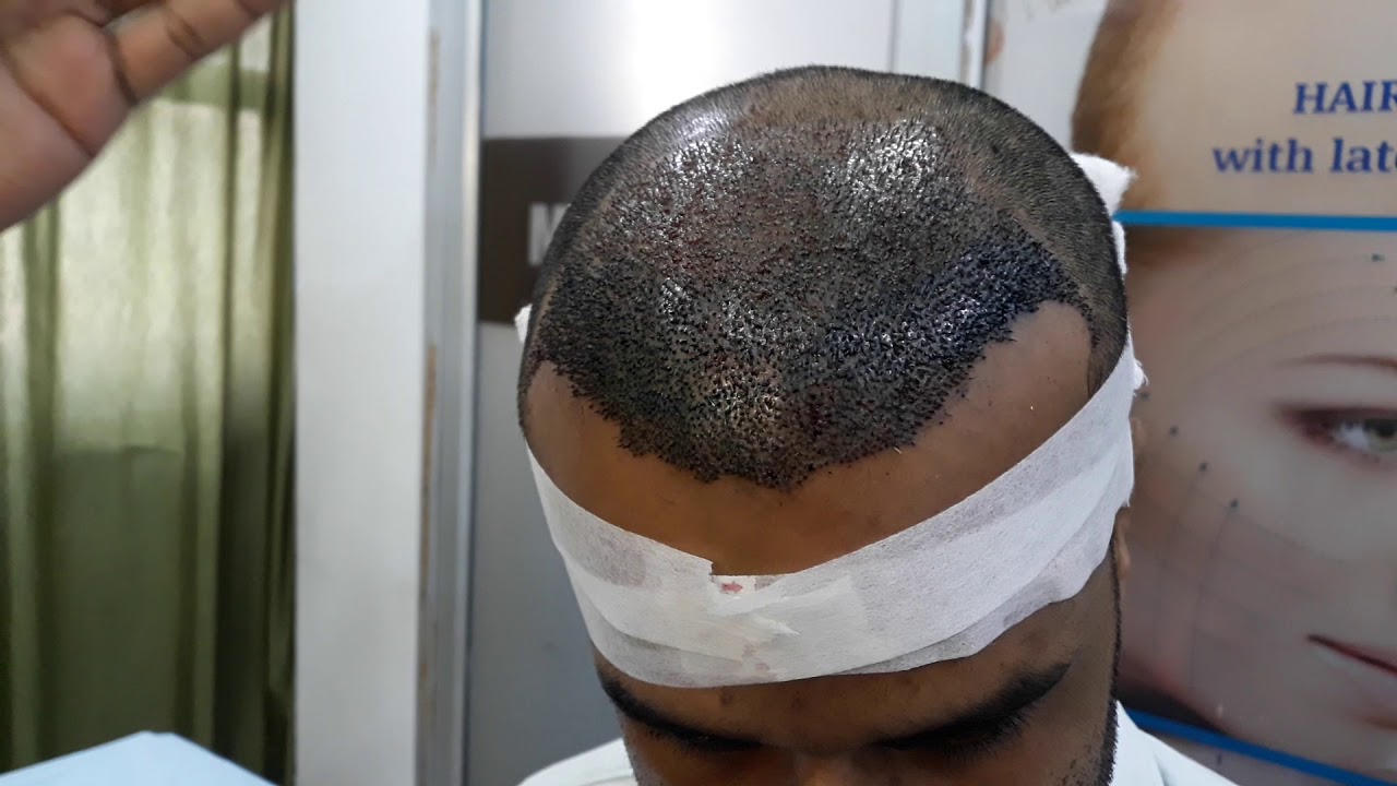 Hair transplant pt. No. 640