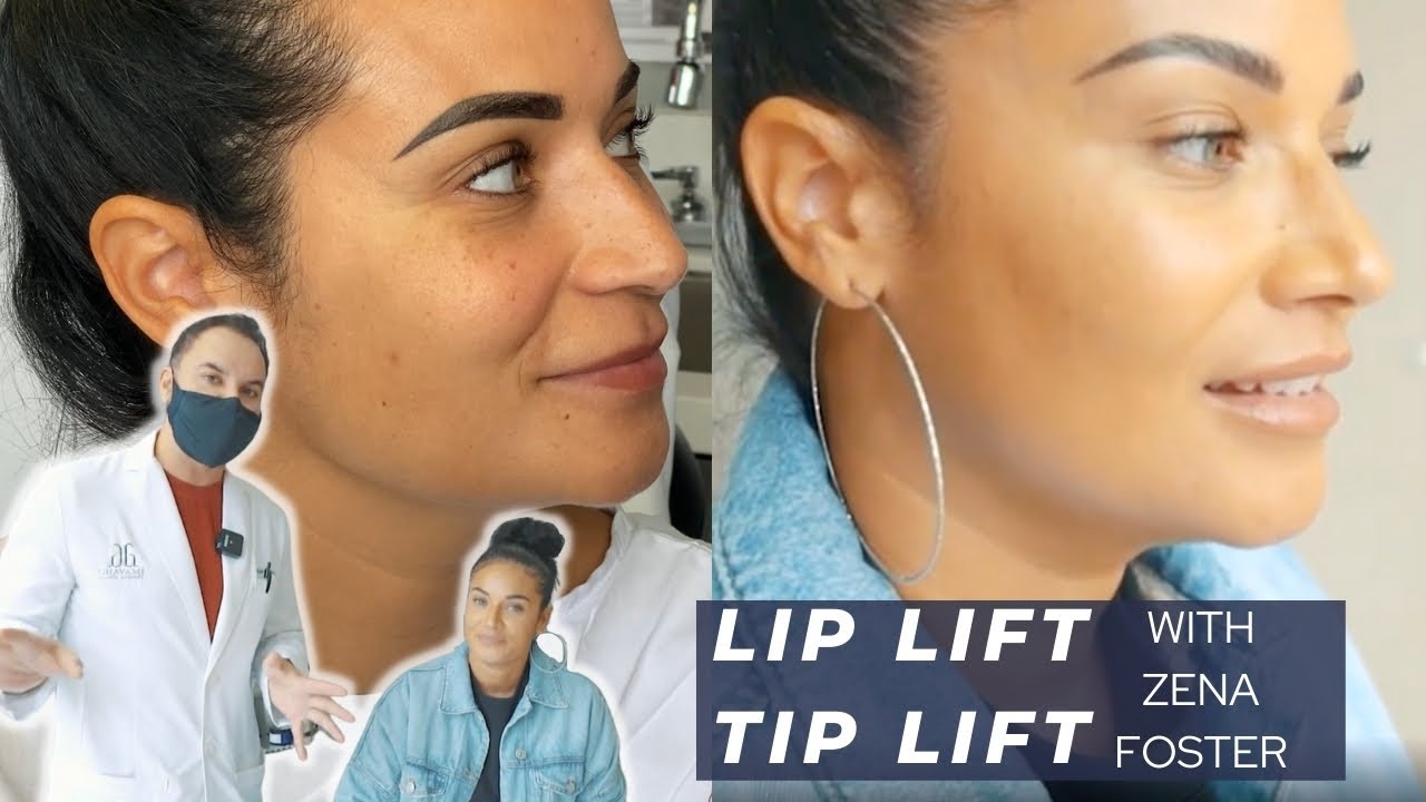 Zena Foster | Lip Lift // Tip Lift | Dr. Ghavami | Tip-Plasty and Lip Lift