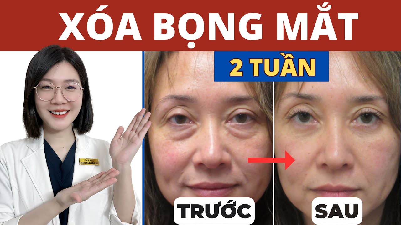 Massage 3 Phút mỗi ngày XÓA BỌNG MẮT sau 2 TUẦN | Thạc sĩ - Bác sĩ Phương Quý