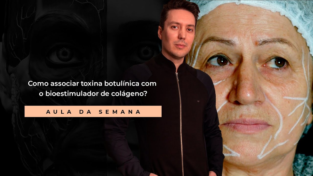 Como associar toxina botul&iacute;nica com o bioestimulador de col&aacute;geno?