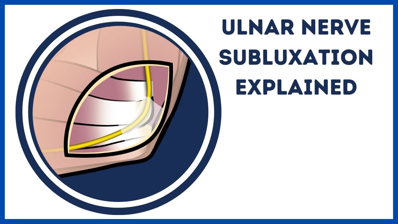 Ulnar Nerve Subluxation / Snapping Ulnar Nerve Explained