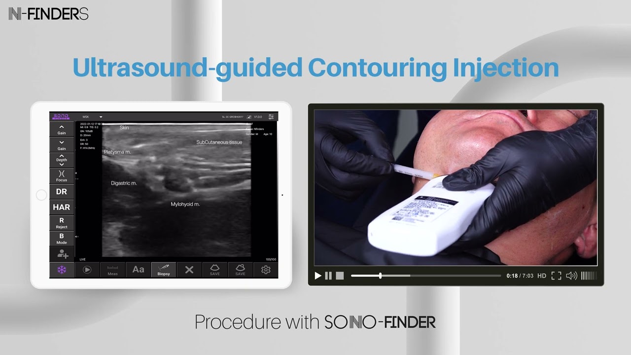Ultrasound-guided BTX Injection