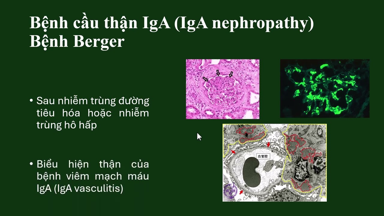 Bệnh lý cầu thận (Khánh Dương)