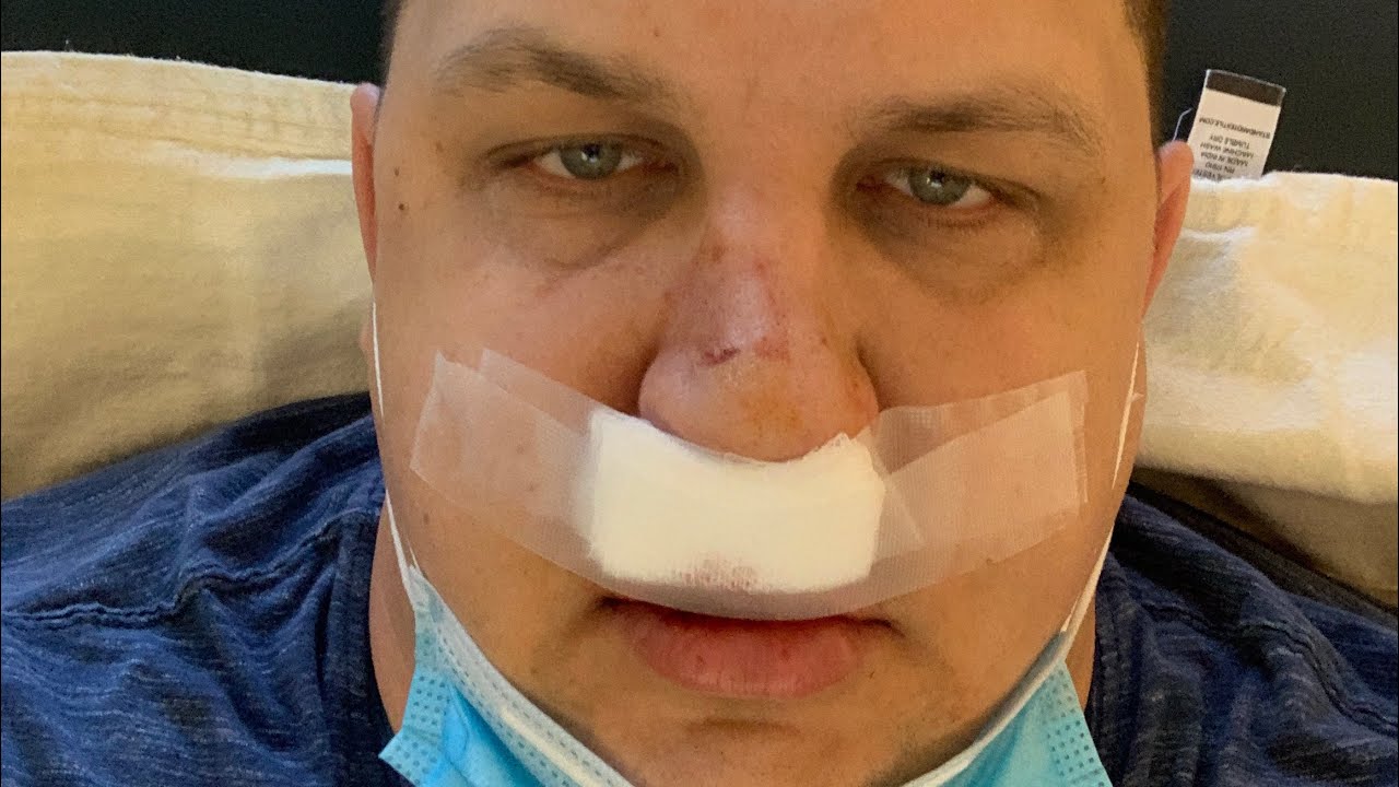 SARPE surgery day 0-4