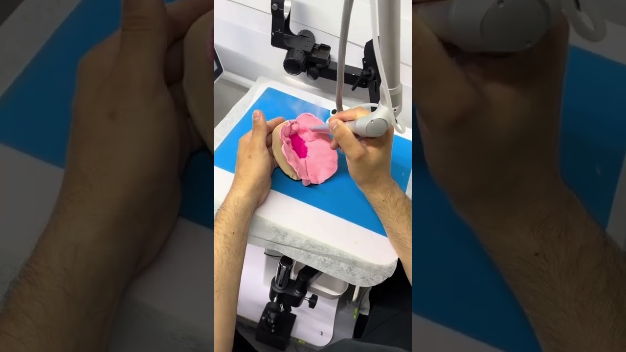 Labioplastia l&aacute;ser en consultorio