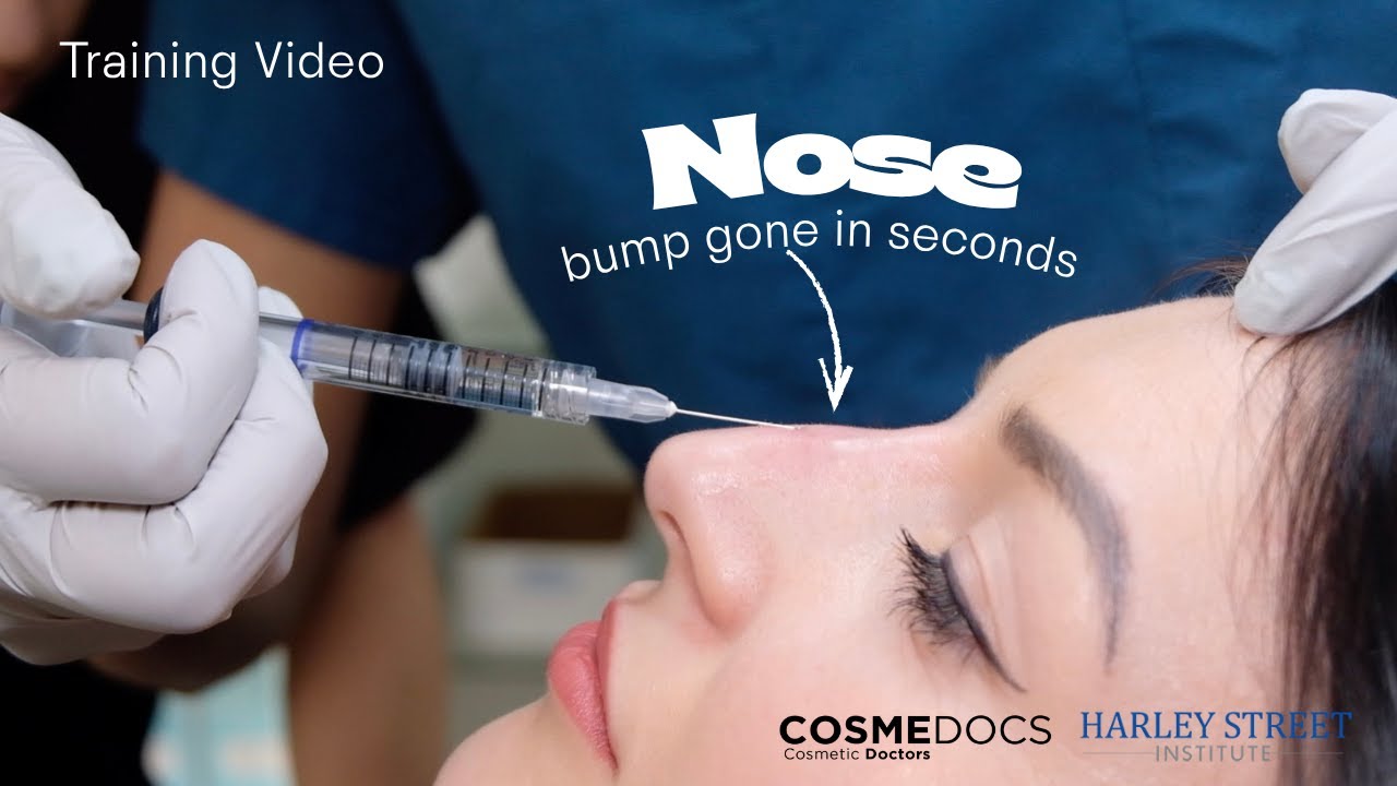 One-Point Non-Surgical Nose Job Using a Cannula | Easy Filler Technique Explained