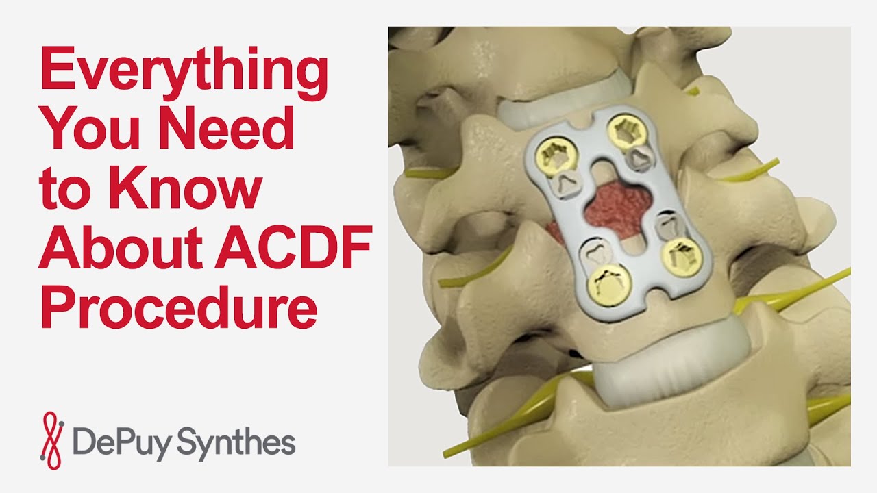 Anterior Cervical Discectomy and Fusion Surgery: Procedure, Risks & Recovery | DePuy Synthes
