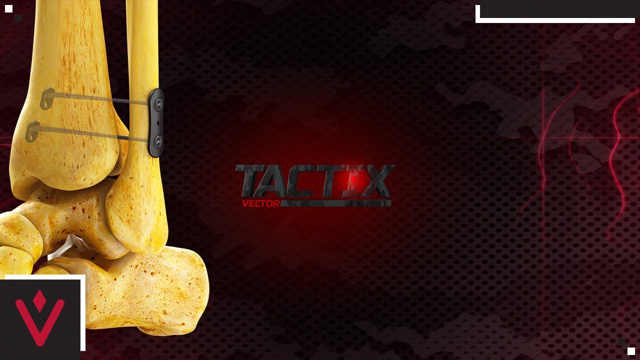TACTIXᵀᴹ Vector | Surgical Technique | Vilex