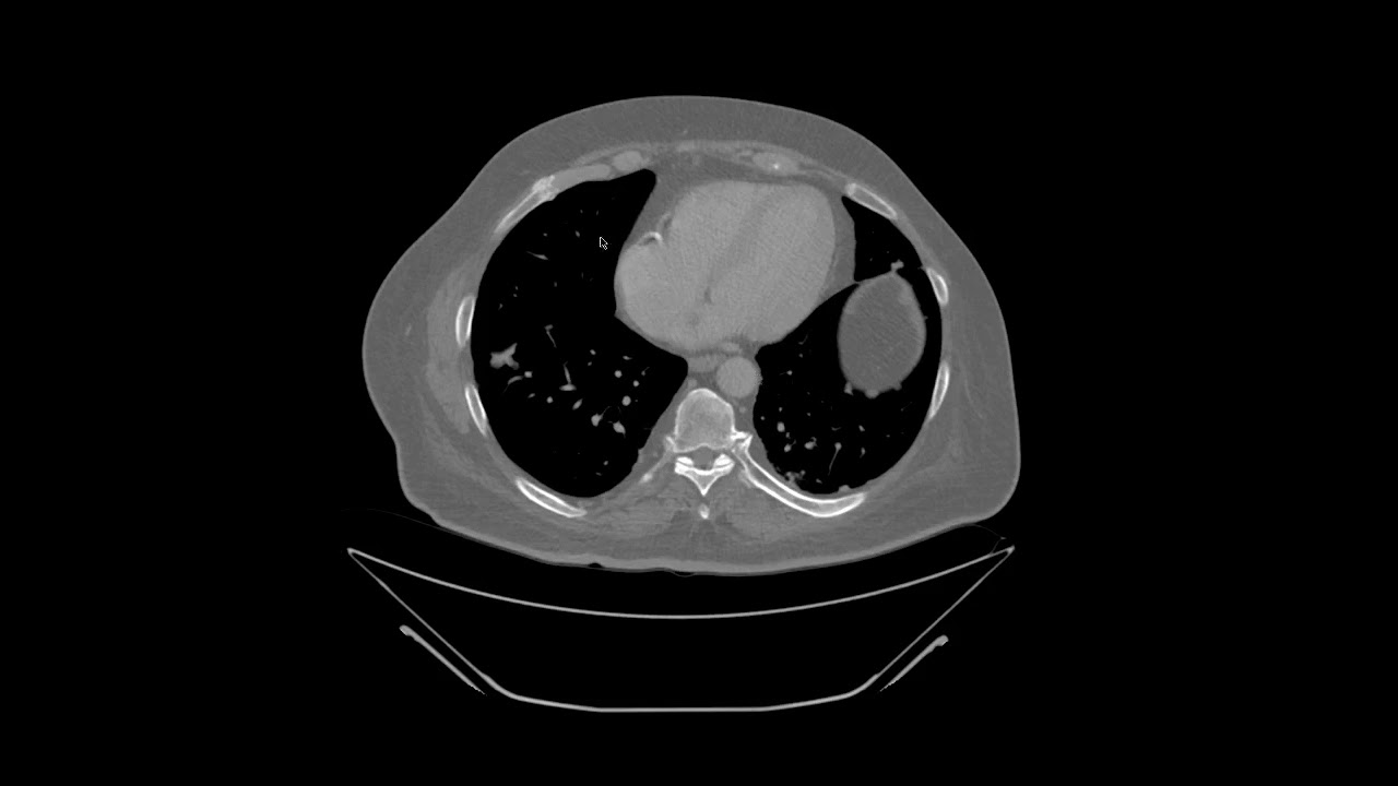 Bone Scintigraphy II : Introduction to Fractures and Metastases