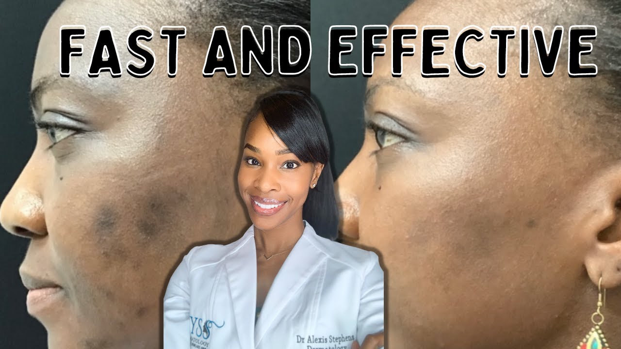 Do Chemical Peels Really Make A Difference?
