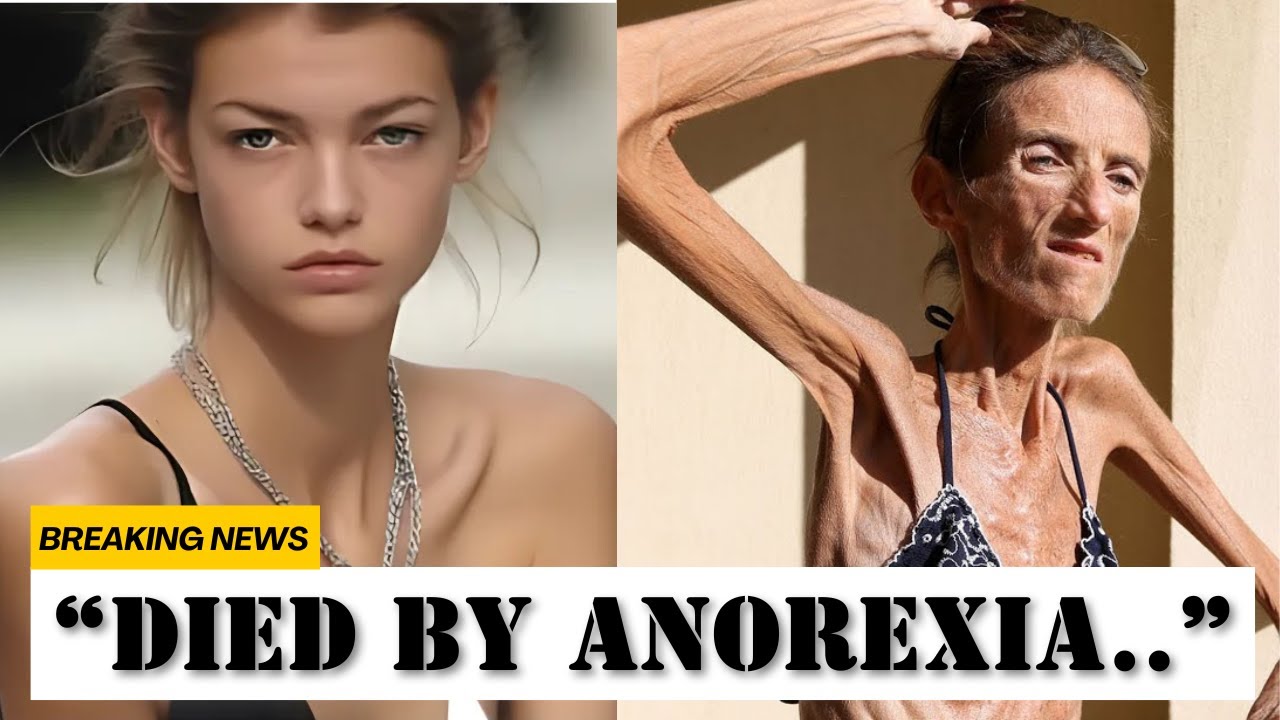 20 Celebrities You Won't Believe DIED OF ANOREXIA