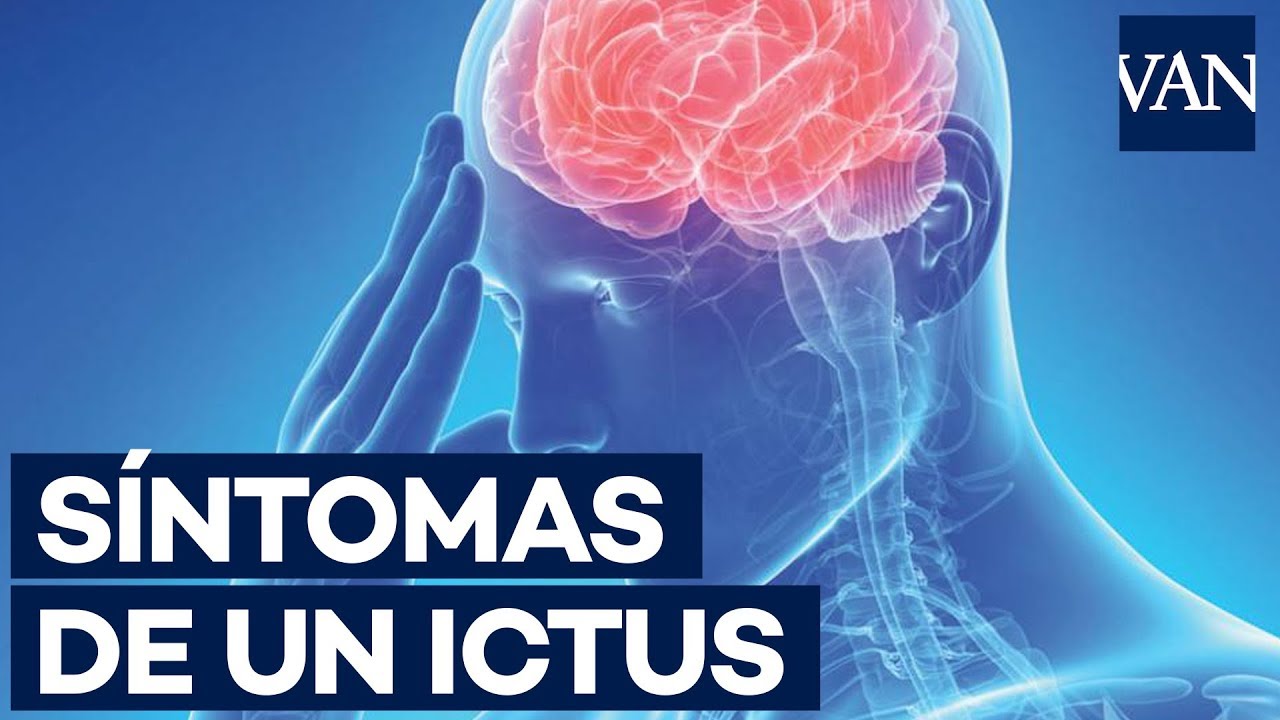 &iquest;Cu&aacute;les son los s&iacute;ntomas de un derrame cerebral?