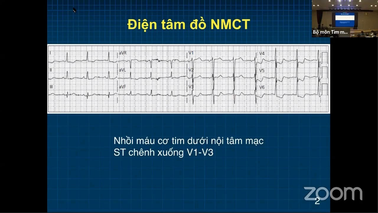 Điện tâm đồ và rối loạn nhịp (ngày 3): ĐTĐ thiếu máu cơ tim