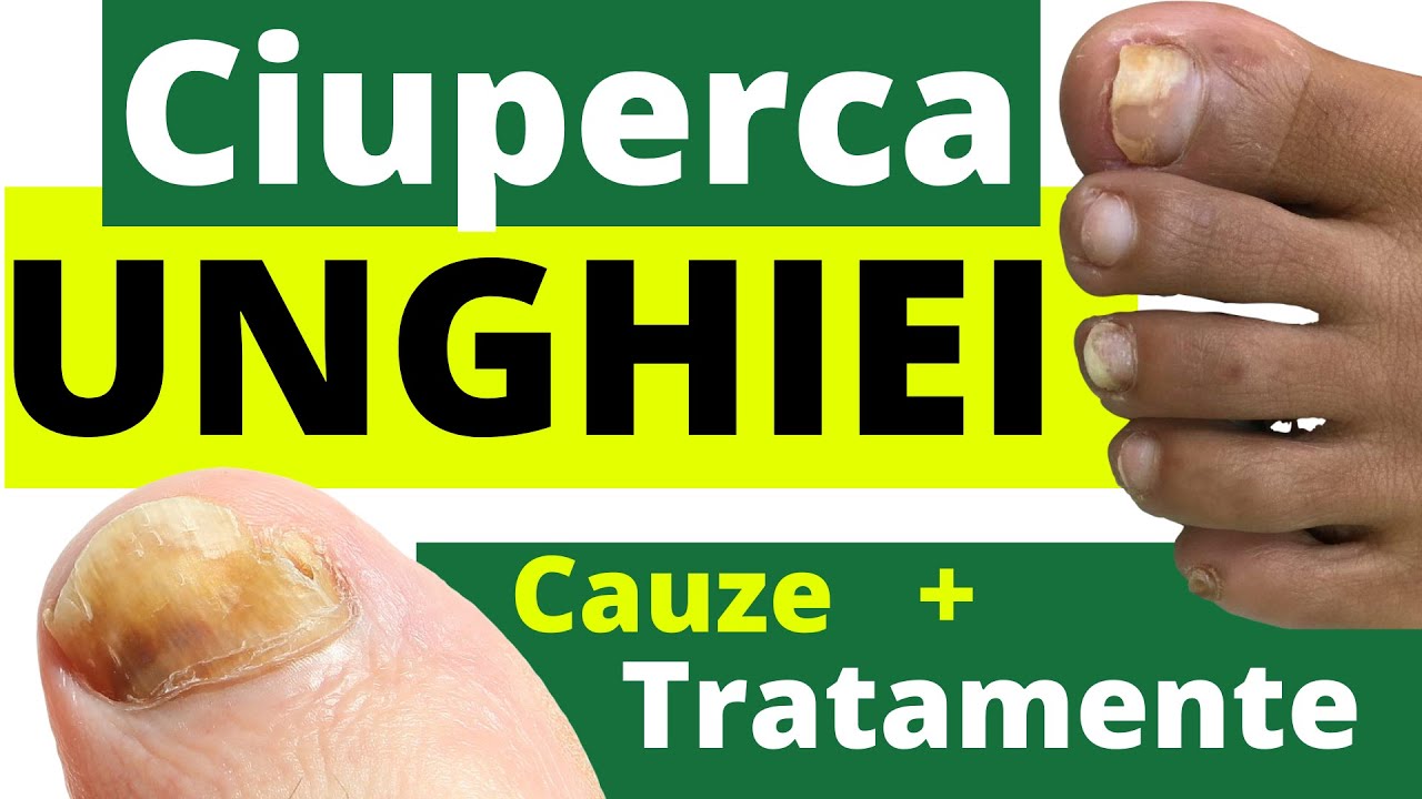 Cum tratezi CIUPERCA UNGHIEI: 5 Remedii simple