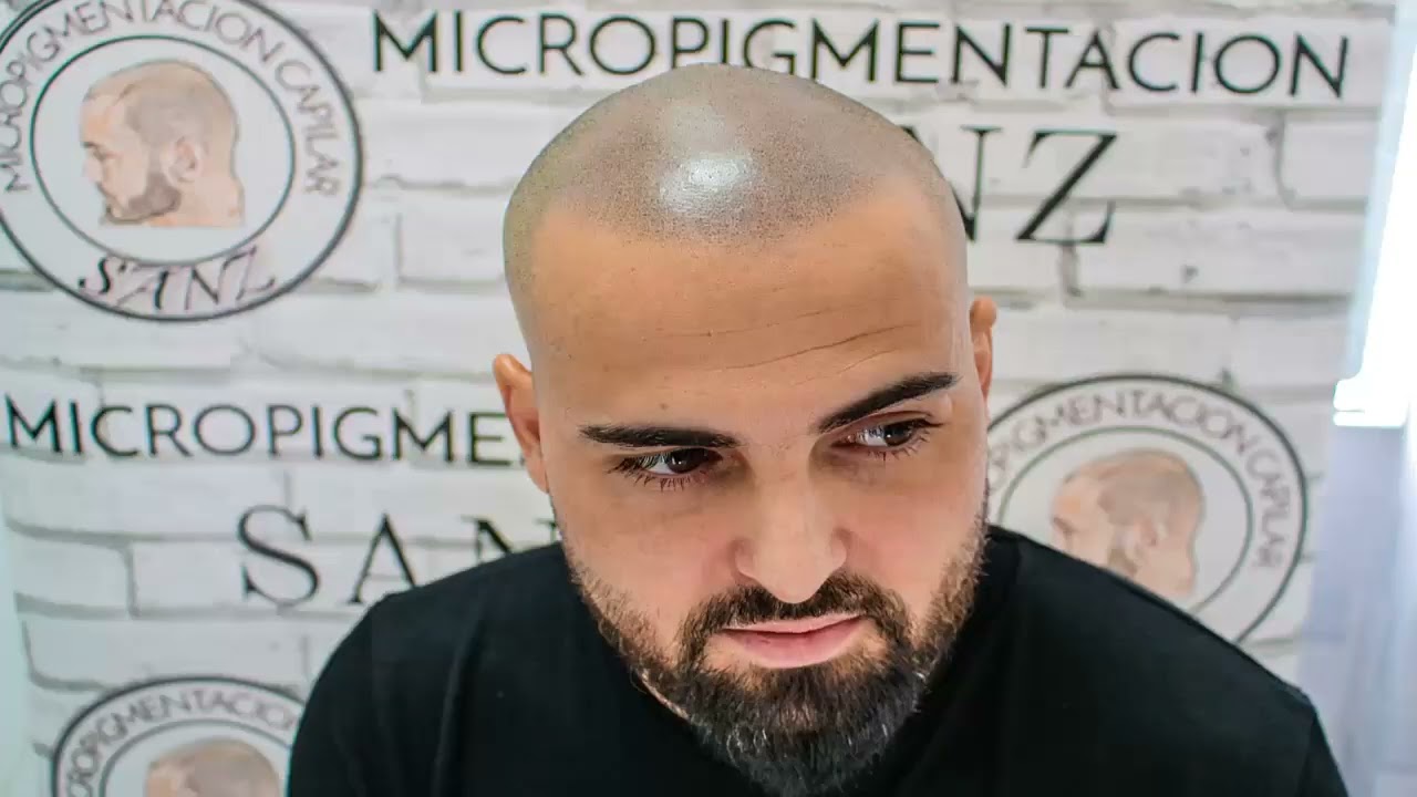 Testimonio de José Luis tras finalizar el tratamiento de Micropigmentacion Capilar.