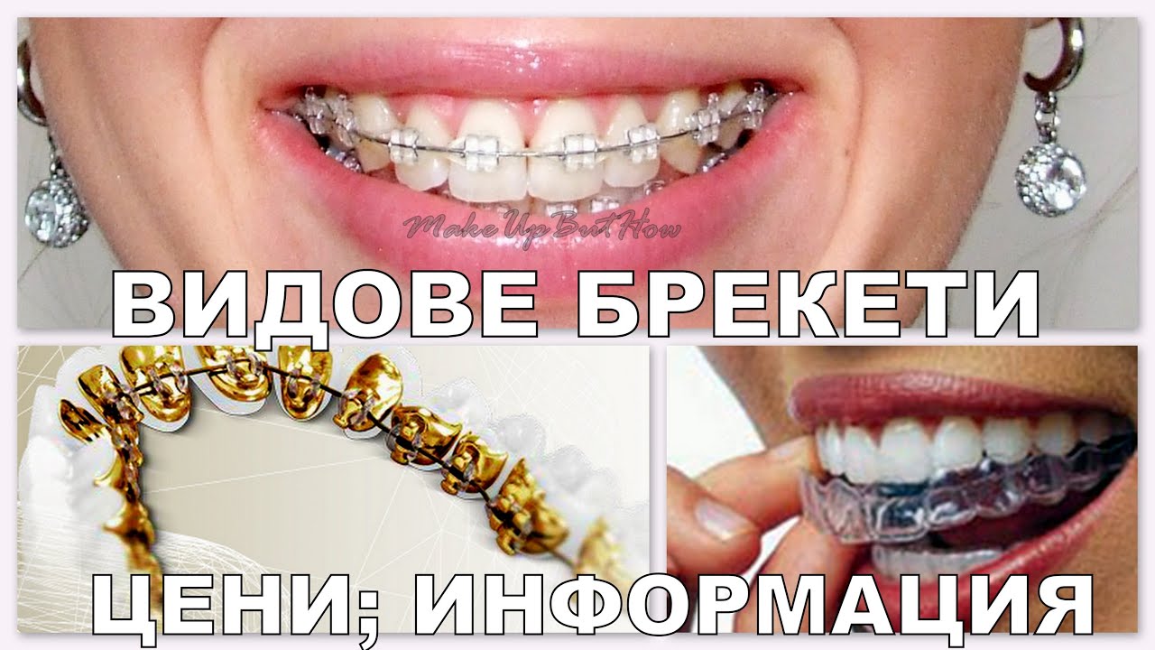 Живот с брекети 2 част ВИДОВЕ БРЕКЕТИ, ЦЕНИ, ИНФОРМАЦИЯ