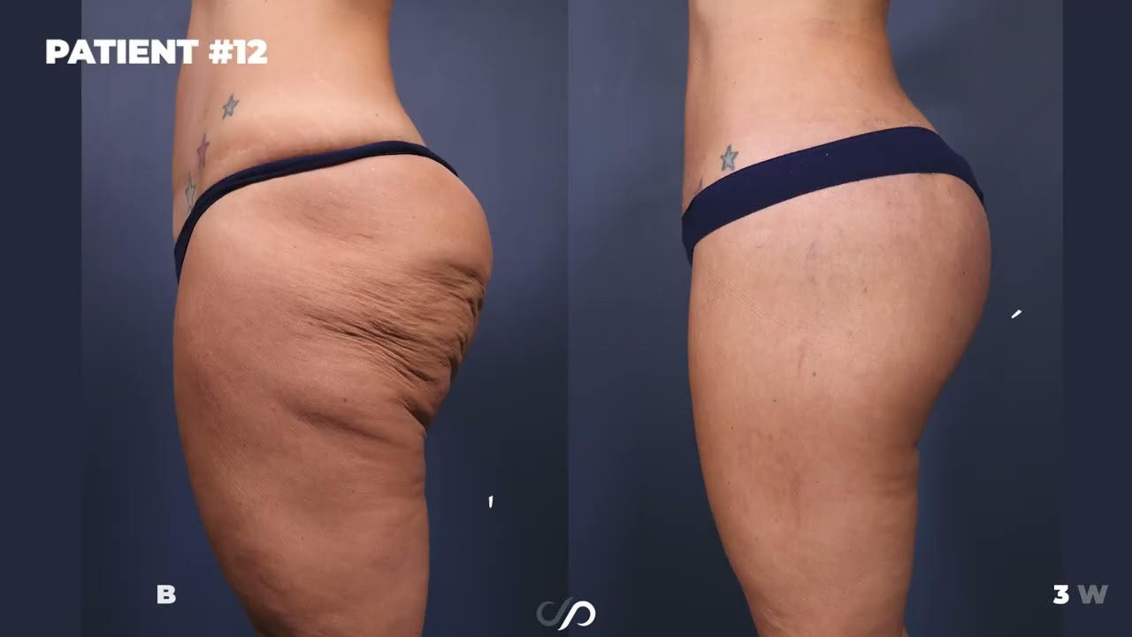 The Bikini Body Lift: Dr. Stoker’s Game-Changing Approach to Skin Tightening & Body Contouring