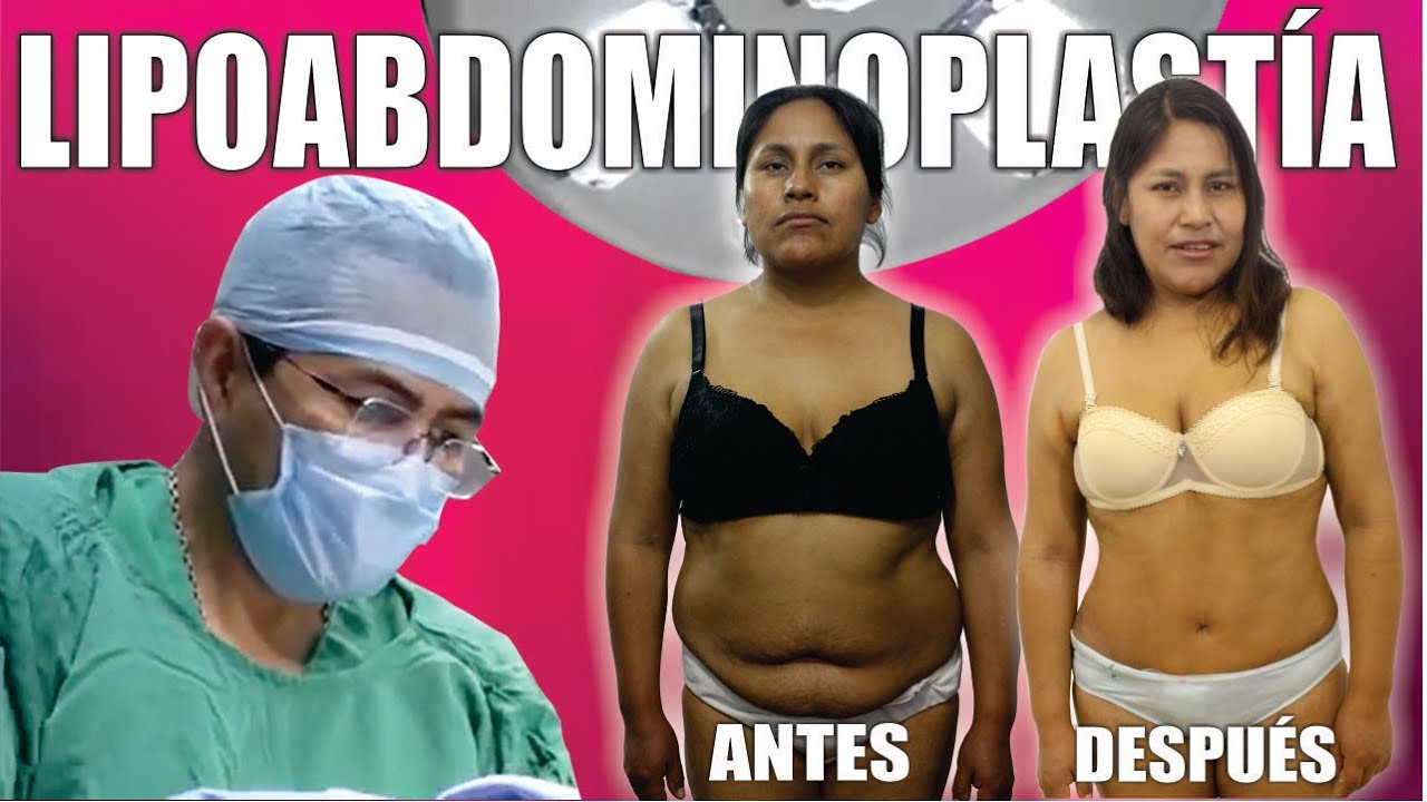 LIPOABDOMINIPLASTÍA DE ANITA ❤️ QUEDÓ REGIA!!! 💋 Lipo + Abdominoplastía en Perú 😍 Dr. Percy Nevado