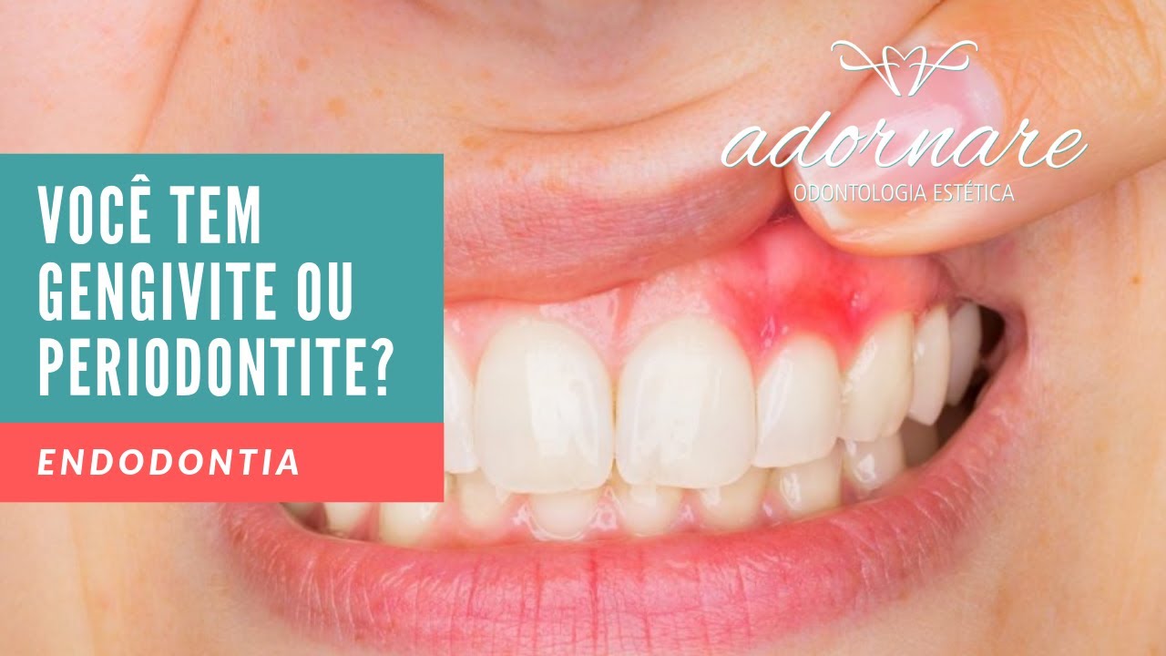 Você sofre de Gengivite ou Periodontite? Dicas de Saúde Bucal - Adornare Odonto