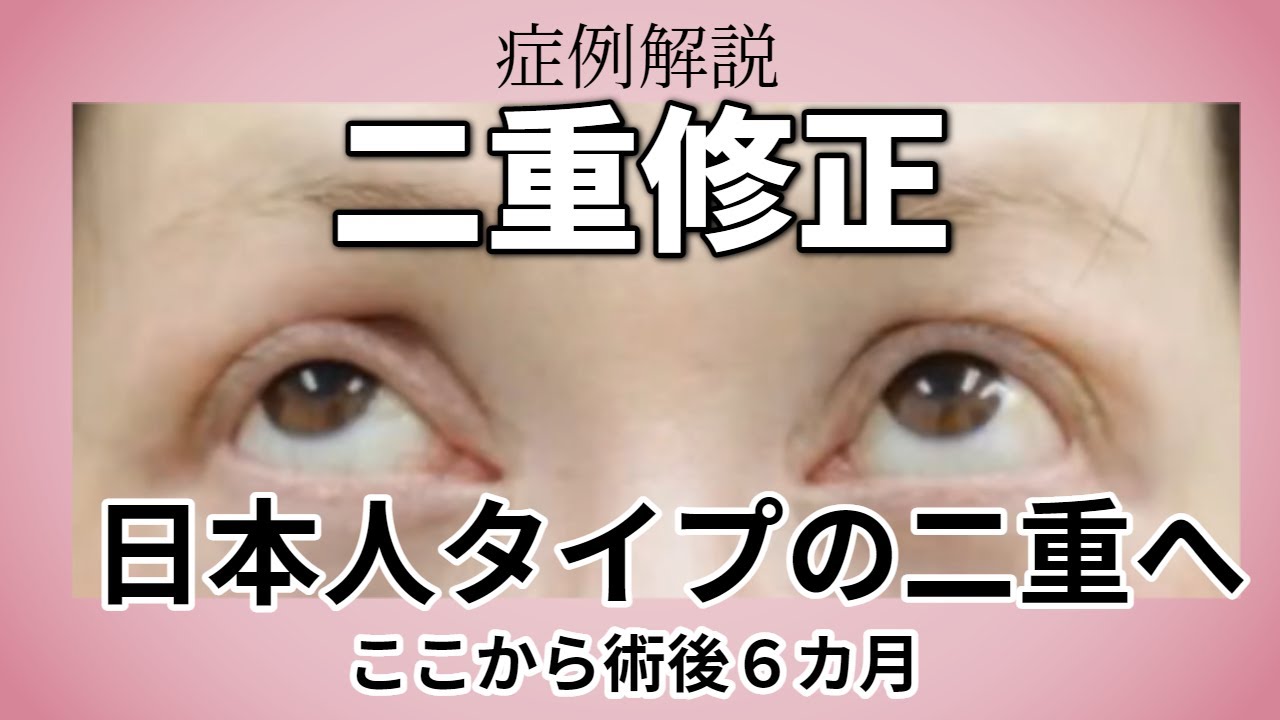 二重修正の症例解説／腱膜固定と吊り上げ、手術後６か月で完成