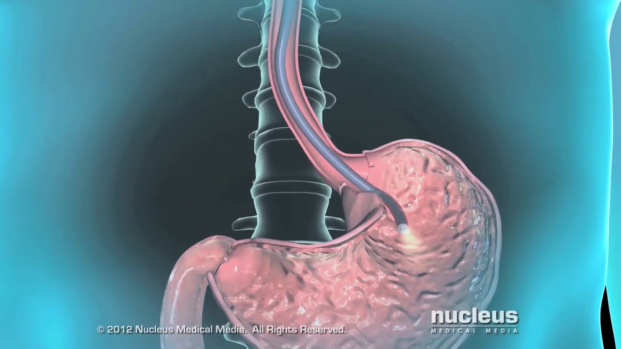 Upper GI Endoscopy at Cook Children's