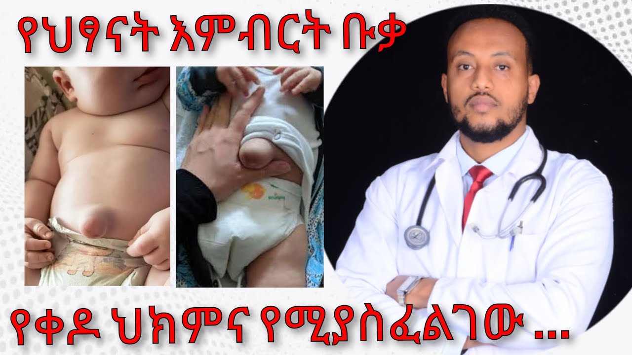 የህፃናት እምብርት ቡቃ የቀዶ ህክምና | Umblical hernia | Dr Yonathan. K | ዶ/ር ዮናታን ከተማ | kedmia letenawo
