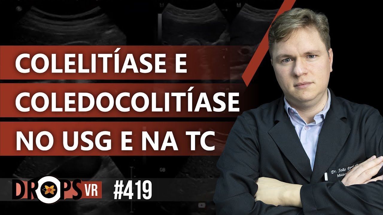 COLELITÍASE E COLEDOCOLITÍASE NO USG E NA TC