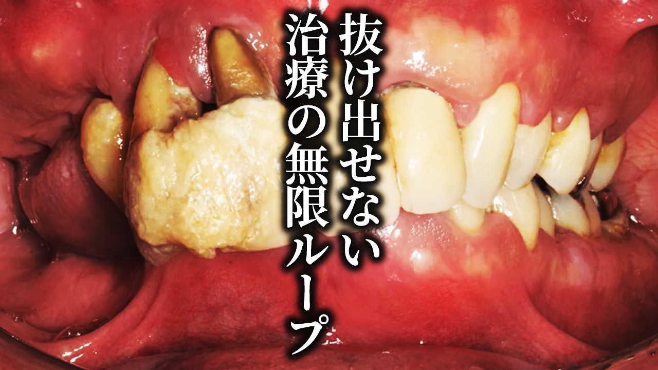 入れ歯も入れた！インプラントも入れた！なのになぜ悪化する！？迷走し続けた10年の苦悩から解放せよ