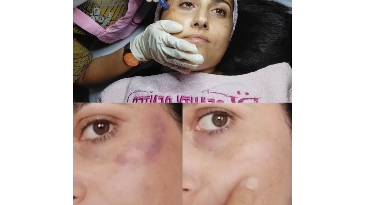 DERMAPEN YAPTIRDIM 💆 GÜN GÜN DEĞİŞİM 👍 #dermapen #değişim #ciltbakımı