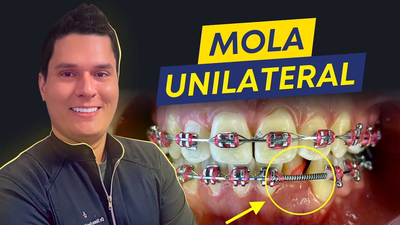 Quando usar mola de um lado só em ortodontia? Relato de caso.