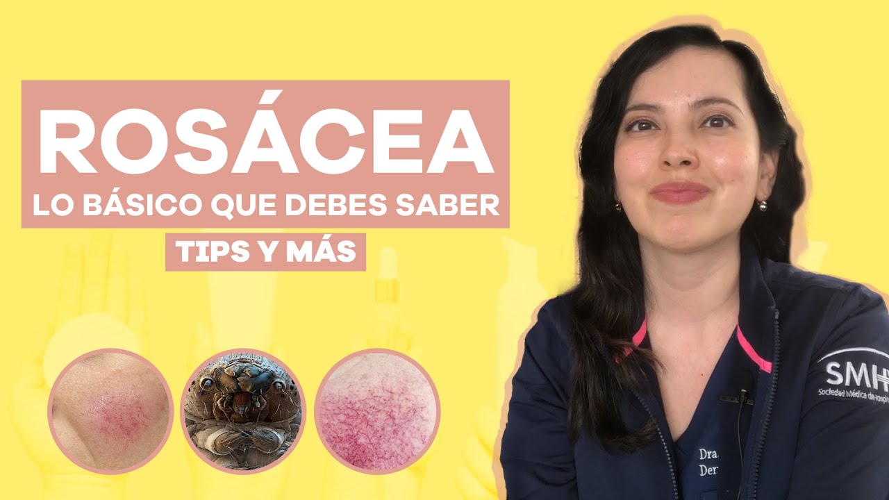 Mejillas rojas todo el tiempo, piel sensible? podría ser Rosácea