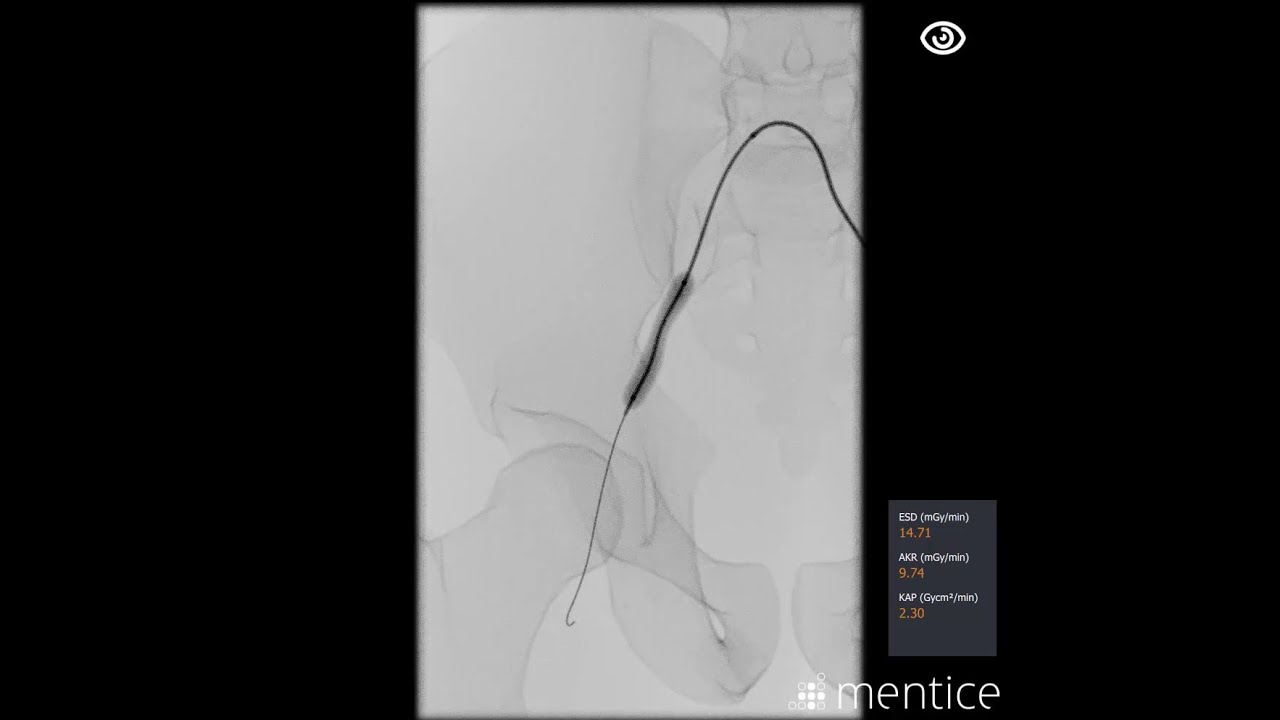 Mentice Iliac Artery Stenoses Intervention Demo