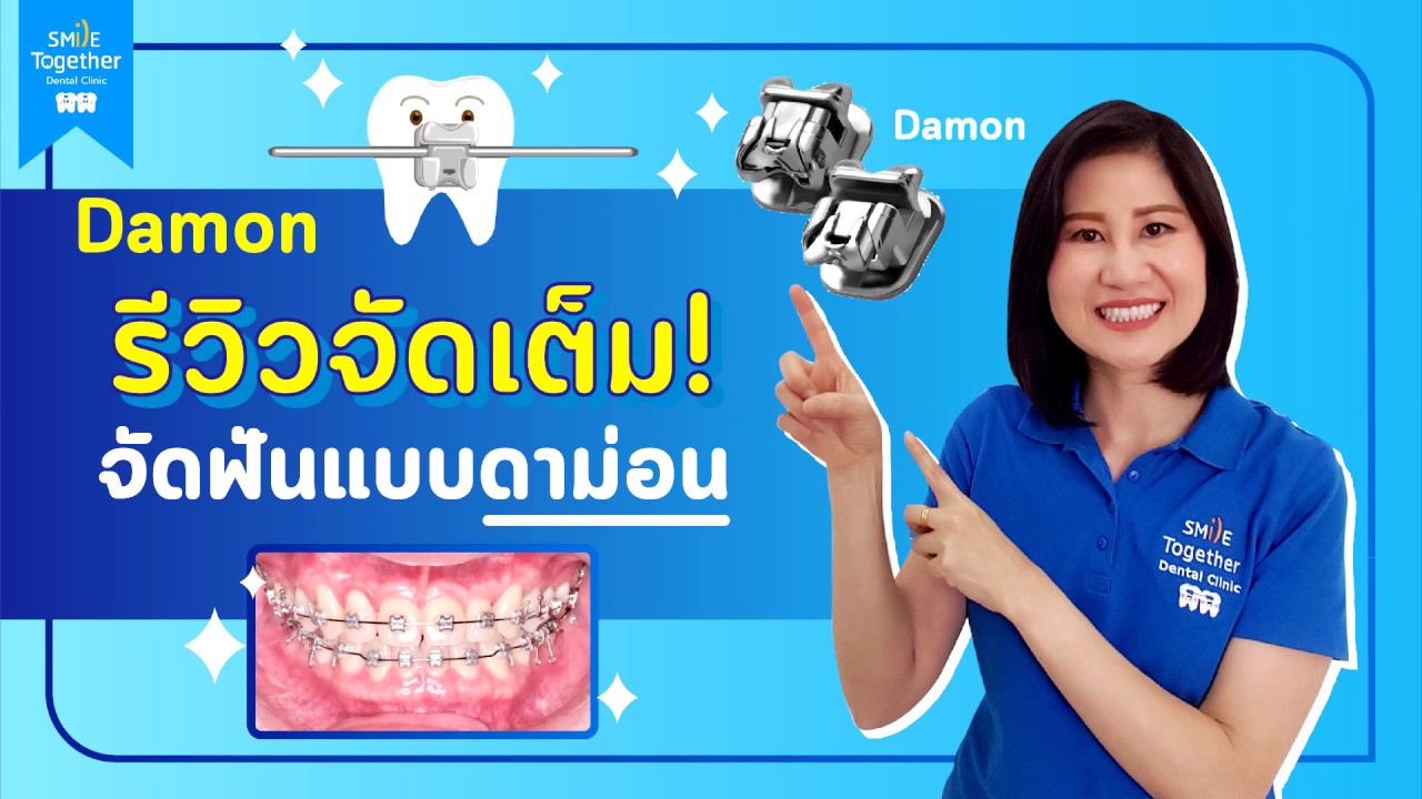 รีวิวจัดฟันดาม่อน ดียังไง+เหมาะกับเคสแบบไหน?