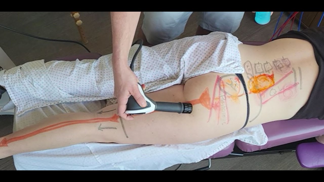 Effective Sciatica Treatment: Shockwave Therapy & Chiropractic Care | Dr. Steve Knighton