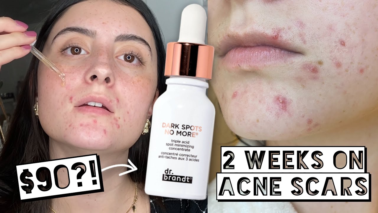 I TESTED $90 Dr. Brandt Dark Spots No More ON MY ACNE SCARS FOR 2 WEEKS