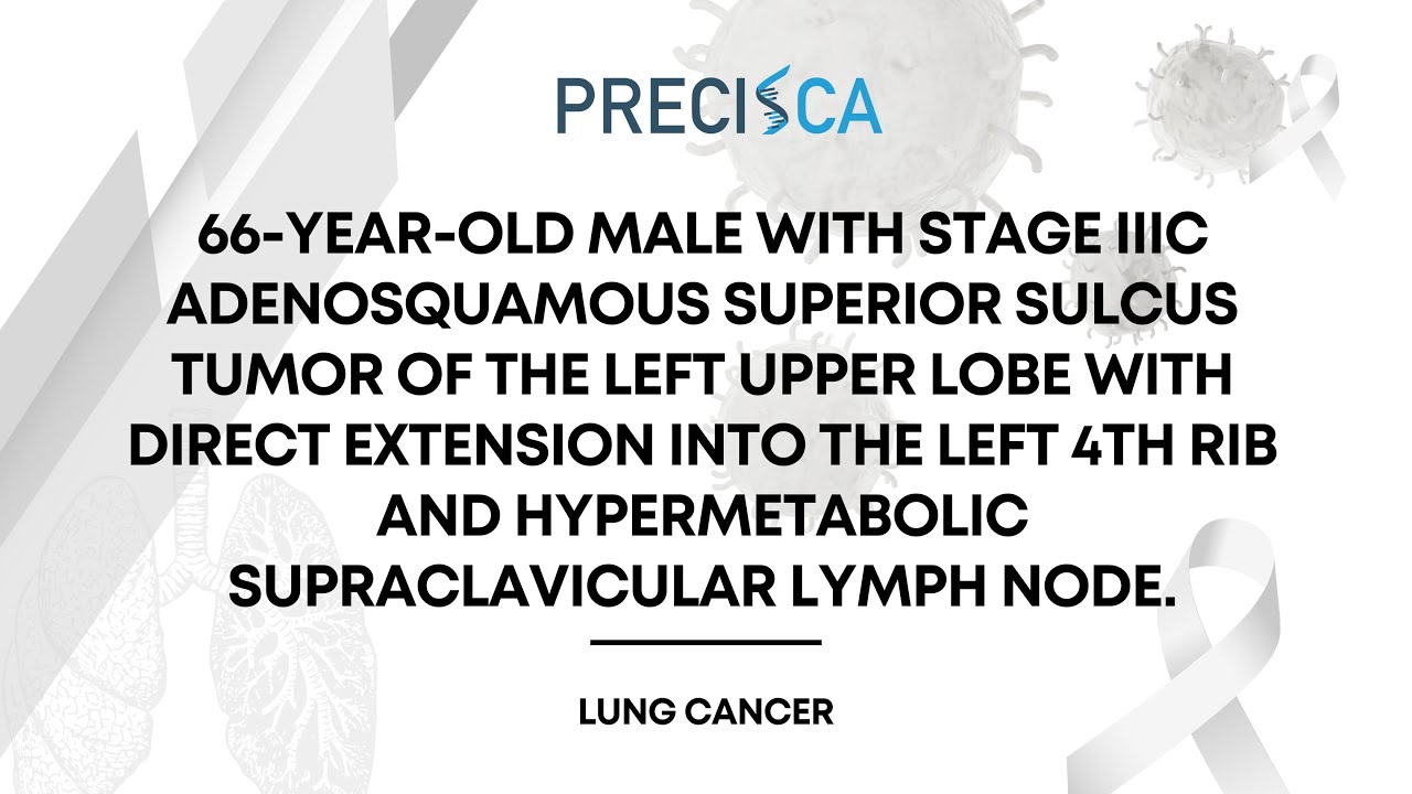 Expert Cancer Panel: Stage IIIC superior sulcus tumor w/ extension to rib and PET-avid supraclav LN