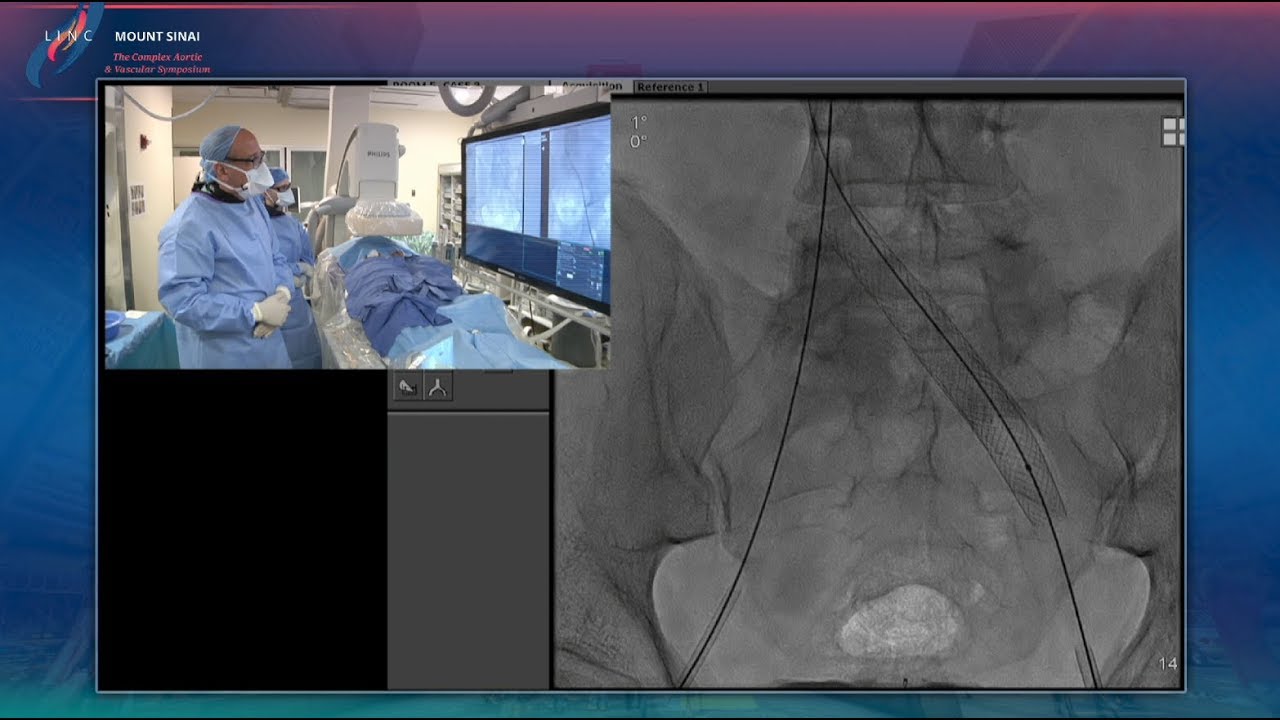 Recanalization of Lower Extremity Venous Stent Occlusion - LINC 2018 LC 8 Sinai_Lookstein - Tues 4pm