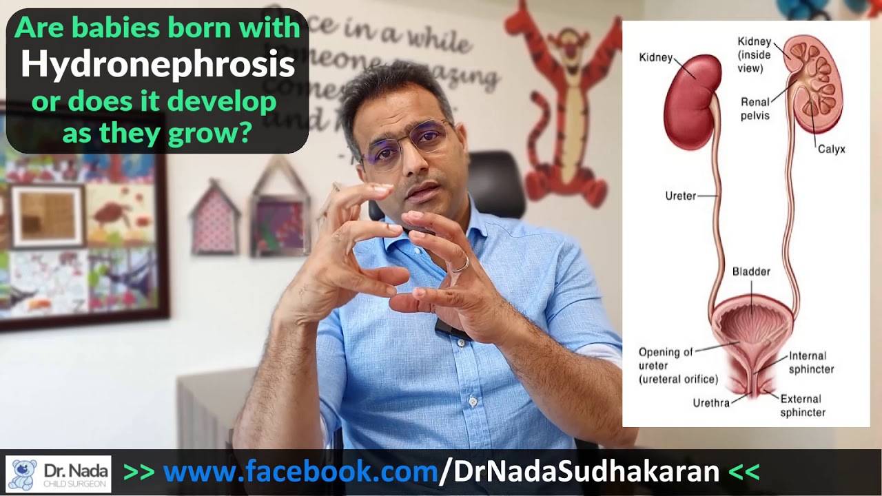 Hydronephrosis in babies & children - causes, symptoms and treatment in Malaysia