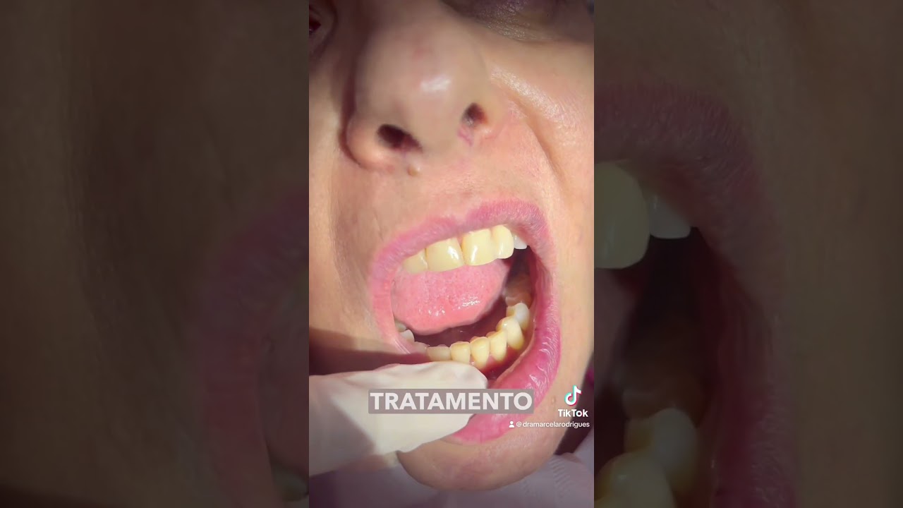 Esse &eacute; o segredo para n&atilde;o sentir dor no clareamento!