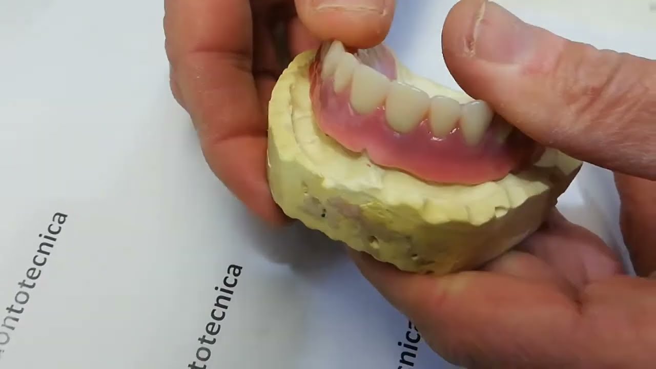 Implantologia protesica, protesi implantare amovibile su una barra avvitata